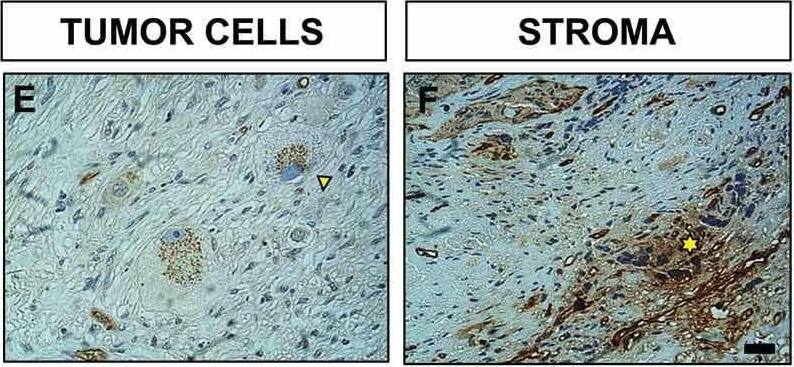Immunohistochemistry of NTN4 expression within NB. Representative light microscopy images of a neuroblastoma sample from a female patient (age > 18M); tumor with retroperotineal location and in disseminated stage. (a) Hematoxylin and eosin staining reveals presence of ganglionar-differentiated cells (yellow arrowhead) and primitive neuroblasts (yellow asterisk). (b) Immunohistochemistry of NTN4 with its corresponding negative control (inset). (c) PCNA staining. (d) NTN4 is expressed preferentially in the endothelium (yellow arrows), as confirmed by CD31 staining (inset). (e) Detail of ganglionar-differentiated cells with strong NTN4 cytoplasmic expression in a characteristic punctuated pattern (yellow arrowhead). (f) Close up image of (b) as indicated, highlighting NTN4 expression within the stroma (yellow asterisk). A, B, C; Scale bar = 40 μm. D, E, F; Scale bar = 10 μm; inset = 10 μm. Image collected and cropped by CiteAb from the following open publication (//pubmed.ncbi.nlm.nih.gov/30160193), licensed under a CC-BY license. Not internally tested by R&D Systems.