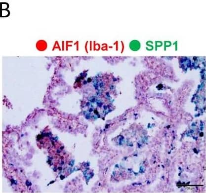 Evaluation of SPP1 expression on cancer cells and macrophages. (A,B). Representative dual ISH (green: SPP1; red: Iba-1) in adenocarcinoma. (C). Representative single-IHC of SPP1 in adenocarcinoma and SCC. (D). Double-IHC of SPP1 and Iba-1 to examine the SPP1 expression level in cancer cells (Iba-1-negative). Double-IHC of SPP1 and PU.1 to examine the SPP1 expression level on TAMs (PU.1-positive in the nucleus). (E). SPP1’s expression level was scored according to the proportion of stained cells as follows: less than 1% staining, score 0; 1% to 49% staining, score 1; more than 50% staining, score 2. The proportions of samples with each score among cancer cells and TAMs in adenocarcinoma and SCC are shown in the pie charts. Image collected and cropped by CiteAb from the following open publication (//www.mdpi.com/2072-6694/14/18/4374), licensed under a CC-BY license. Not internally tested by R&D Systems.