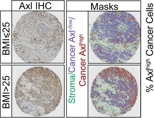 TGF beta  promotes HLA-ABC downregulation at baseline and in response to IFN gamma .a IFN gamma -mediated induction (IFN gamma -treated/vehicle-treated control) of cell surface HLA-ABC in MITFhigh/AXLlow or /MITFlow/AXLhigh short-term PD-1 PROG melanoma cell lines. Each dot represents one cell line and HLA-ABC induction was measured by flow cytometry 24 h after treating cultures with vehicle control or 1000 U/ml IFN gamma . Box plots show the median and interquartile ranges, and data were compared using Mann-Whitney test. b Cell surface expression (median fluorescence intensity; MFI) of HLA-ABC in WMD-084, SCC14-0257 and SMU17-0132 melanoma cells treated with vehicle (Control), 1000 U/ml IFN gamma  and/or 10 ng/ml TGF beta  for 72 h. Data (mean ± s.d.) were compared using one-way ANOVA with the Geisser-Greenhouse correction. c Expression of de-differentiation markers AXL, N-cadherin and SNAIL in WMD-084, SCC14-0257 and SMU17-0132 melanoma cells treated with vehicle (Control), 1000 U/ml IFN gamma - and/or 10 ng/ml TGF beta  for 72 h. d IFN gamma  production after co-culture of TGF beta  pre-treated (10 ng/ml for 72 h) melanoma cells with the patient-matched tumor-infiltrating lymphocytes expanded from the same tumor biopsy. IFN gamma  was measured by flow cytometry. Data (mean ± s.d.) show relative IFN gamma  expression in T cells (TGF beta  pre-treated/BSA pre-treated) after background subtraction (spontaneous IFN gamma  production on immune cell-only cultures). Paired BSA-treated vs TGF beta -treated data were compared using paired t-test, **p  25, n = 23 for CD133; n = 21 for Axl) or low (BMI ≤ 25, n = 13 for CD133; n = 11 for Axl) BMI PM/ER−/PR− patients’ tumor samples, stroma is marked in green, CD133− or Axl−/low cancer cells are marked in blue and positive staining cancer cells are marked in red (for c, P = 0.0245; d, P = 0.023). e Time-dependent proliferation assay of ex vivo E0771 cells isolated from chow or HFD-fed mice. For each time point, data are represented as mean ± SEM of four tumor samples (eight replicates per tumor sample were measured) from each group. f Tumorsphere formation assay of E0771 ex vivo cells isolated from chow diet or HFD-fed mice. Representative images of day-5 tumorspheres formation of E0771 ex vivo cells and red arrowheads mark the identified tumorspheres. Quantification of day-5 tumorspheres is represented as mean ± SEM of four tumor samples from each group and three replicates were measured for each sample, P = 0.0002. g Fatty acid and glucose oxidation on E0771 ex vivo cells isolated from two chow diet-fed mice and three HFD-fed mice. The oxidation data are normalized to cell protein content. For each sample, 8 replicates are measured and data are represented as mean ± SEM of all replicates from each group. Fatty acid oxidation P = 0.0002, Glucose oxidation P = 0.0365. For c, d, unpaired, two-tailed Welch’s t-test was used for statistical testing. For f, g, statistical significance determined with unpaired, two-tailed Student’s t-test (*P value <0.05; ***P value <0.001). Source data are provided as a Source data file. Image collected and cropped by CiteAb from the following publication (//pubmed.ncbi.nlm.nih.gov/35013251), licensed under a CC-BY license. Not internally tested by R&D Systems.