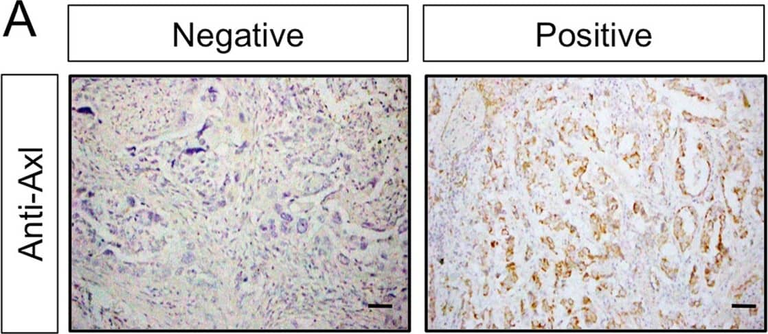 Expression of Axl and Gas6 in clinical samples. (A,B) Immunohistochemical analysis of Axl (A) or Gas6 (B) in non-small cell lung cancer tissues from patients who underwent surgery following preoperative chemotherapy or chemoradiotherapy. Insets show higher magnification of the areas indicated in the boxes. Scale bar, 50 μm. (A) Representative images showing tumor Axl-negative tumor tissues (left), and tumor Axl-positive tumor tissues (right). Tissues were stained with an anti-Axl antibody (brown) and counterstained with hematoxylin. (B) Representative images showing stromal Gas6-negative tumor tissues (left) and stromal Gas6-positive tumor tissues (right). Tissues were stained with an anti-Gas6 antibody (brown) and counterstained with hematoxylin. (C) Correlation between tumor Axl expression and stromal Gas6 expression in tumor tissues observed in (A and B). (D) Correlation between tumor Axl, stromal Gas6 expression and survival. Kaplan–Meier plot of disease-free survival in patients with non-small cell lung cancer who underwent surgery following preoperative chemotherapy or chemoradiotherapy, stratified according to tumor Axl and stromal Gas6 expression. Five-year disease-free survival in the patients with tumors expressing both tumor Axl and stromal Gas6 (n = 37) was significantly worse than in the both-negative group (n = 12) (21.9% vs 51.3%, p = 0.04). The five-year disease-free survival of tumor Axl-negative and stromal Gas6-positive group was 50.7%, and the difference in survival between this group and both-positive or both-negative group was not significant (p = 0.20 and 0.49, respectively); *p < 0.05. Image collected and cropped by CiteAb from the following publication (//pubmed.ncbi.nlm.nih.gov/28878389), licensed under a CC-BY license. Not internally tested by R&D Systems.