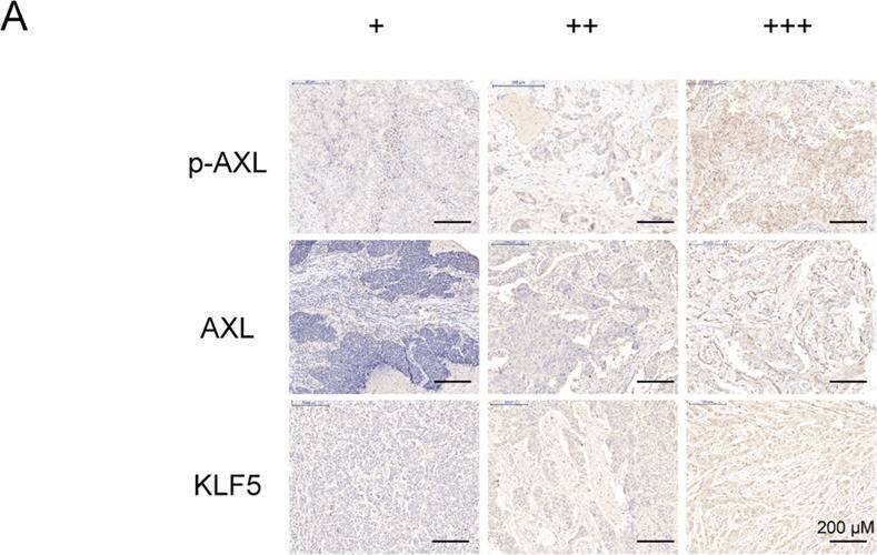 The expression of p-AXL&AXL positively correlates with the expression of KLF5 in human TNBC specimens. Moreover, DCC-2036 increases the sensitivity of TNBC chemotherapy by decreasing BCSCs.A Representative immunohistochemical staining images of p-AXL, AXL,&KLF5 protein in TNBC specimens, in which the expression of p-AXL, AXL,&KLF5 proteins was indicated by mild positive (+), moderate positive (++),&strong positive (+++), respectively. Left: Scale bars, 200 μm (magnification 40×); Right: Scale bars, 50 μm (magnification 100×). Image collected & cropped by CiteAb from the following open publication (//pubmed.ncbi.nlm.nih.gov/36042208), licensed under a CC-BY license. Not internally tested by R&D Systems.