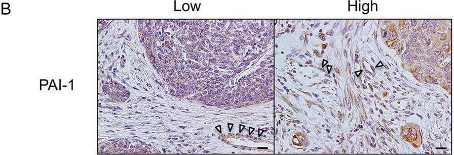 The expression of PAI-1 and LRP1 in human ESCC tissues. A Immunohistochemical staining for PAI-1 in human ESCC tissues. Representative images are shown: PAI-1 low-intensity in the stroma (left) and PAI-1 high-intensity in the stroma (right). Scale bars = 100 μm. b High-power fields of immunohistochemical staining for PAI-1 in same cases as Fig. 6a. Scale bars = 20 μm. Arrow heads: vascular endothelial cell. c Immunohistochemical staining for LRP1 in cancer nest of human ESCC tissues. Representative images are shown: LRP1 low-intensity in cancer nest (left) and LRP1 high-intensity in cancer nest (right). Scale bars = 100 μm. d Immunohistochemical staining for LRP1 in the stroma of human ESCC tissues. Representative images are shown: LRP1 low-intensity in the stroma (left) and LRP1 high-intensity in the stroma (right). Scale bars = 20 μm. e Stromal cells, including CD204+ TAMs, expressed LRP1 in human ESCC tissue. Double immunofluorescence was performed using anti-LRP1 (green) and anti-CD204 (red) antibodies in formalin-fixed paraffin-embedded section of human ESCC tissue. LRP1 was expressed in both cancer cells and stromal cells, and some of the LRP1-positive stromal cells were CD204+ macrophages (arrow heads). Nuclei were stained with DAPI (blue). Scale bar = 20 μm. CA cancer nest. ST stroma. Image collected and cropped by CiteAb from the following open publication (//pubmed.ncbi.nlm.nih.gov/33311557), licensed under a CC-BY license. Not internally tested by R&D Systems.