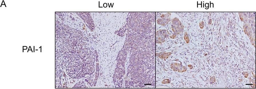 The expression of PAI-1 and LRP1 in human ESCC tissues. A Immunohistochemical staining for PAI-1 in human ESCC tissues. Representative images are shown: PAI-1 low-intensity in the stroma (left) and PAI-1 high-intensity in the stroma (right). Scale bars = 100 μm. b High-power fields of immunohistochemical staining for PAI-1 in same cases as Fig. 6a. Scale bars = 20 μm. Arrow heads: vascular endothelial cell. c Immunohistochemical staining for LRP1 in cancer nest of human ESCC tissues. Representative images are shown: LRP1 low-intensity in cancer nest (left) and LRP1 high-intensity in cancer nest (right). Scale bars = 100 μm. d Immunohistochemical staining for LRP1 in the stroma of human ESCC tissues. Representative images are shown: LRP1 low-intensity in the stroma (left) and LRP1 high-intensity in the stroma (right). Scale bars = 20 μm. e Stromal cells, including CD204+ TAMs, expressed LRP1 in human ESCC tissue. Double immunofluorescence was performed using anti-LRP1 (green) and anti-CD204 (red) antibodies in formalin-fixed paraffin-embedded section of human ESCC tissue. LRP1 was expressed in both cancer cells and stromal cells, and some of the LRP1-positive stromal cells were CD204+ macrophages (arrow heads). Nuclei were stained with DAPI (blue). Scale bar = 20 μm. CA cancer nest. ST stroma. Image collected and cropped by CiteAb from the following open publication (//pubmed.ncbi.nlm.nih.gov/33311557), licensed under a CC-BY license. Not internally tested by R&D Systems.