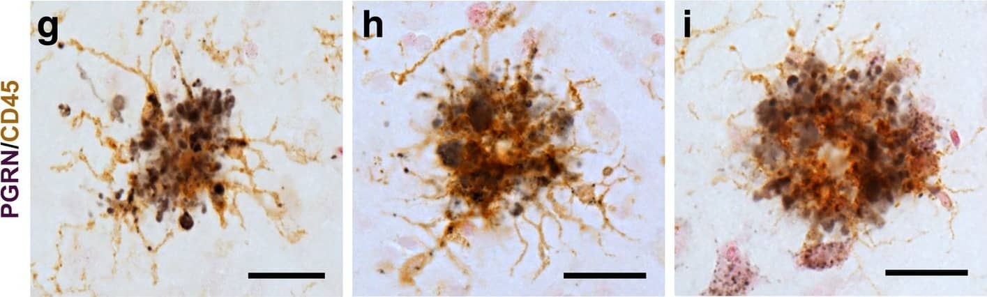 Progranulin Interactions with AD pathological Features. (a-c). Representative photomicrographs of progranulin (PGRN)(purple) immunoreactivity associated with amyloid beta (A beta ) plaques (brown) in MTG sections of low plaque, high plaque and Alzheimer’s disease cases. Scale bar represents 30 μm. (d-f). Photomicrographs of PGRN (purple) immunoreactivity associated with CD45 immunoreactive microglia in MTG sections of low plaque (d), high plaque (e), and Alzheimer’s disease cases (f). Insets a) show at higher magnification PGRN-positive stained neurons present in each section. Neurons are identified by their size and characteristic shape. Insets b) show higher magnification of PGRN-positive microglia. Scale bar represents 20 μm (d-f), and 10 μm for insets. (g-i). Photomicrographs of PGRN (purple) with plaque-associated CD45-positive microglia (brown). Progressive increase in accumulation of CD45-positive microglia in low plaque (g), high plaque (h) and Alzheimer’s disease (i) cases. Scale bar represents 30 μm. (j-o). Absence of PGRN immunoreactivity of neurofibrillary tangles. (j-i) Photomicrographs of PGRN (purple) and phosphorylated tau (AT8)(brown) double-stained sections from low plaque (j), high-plaque (k), and Alzheimer’s disease cases (l). (m-o). Confocal micrographs of PGRN (green) and phosphorylated tau (AT180)-positive tangles in low-plaque (m), high-plaque (n) and Alzheimer’s disease (o) cases. Scale bar represents 10 μm. Image collected and cropped by CiteAb from the following publication (//pubmed.ncbi.nlm.nih.gov/31864418), licensed under a CC-BY license. Not internally tested by R&D Systems.