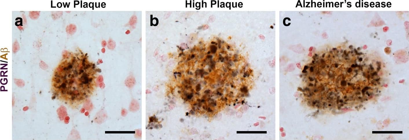 Progranulin Interactions with AD pathological Features. (a-c). Representative photomicrographs of progranulin (PGRN)(purple) immunoreactivity associated with amyloid beta (A beta ) plaques (brown) in MTG sections of low plaque, high plaque and Alzheimer’s disease cases. Scale bar represents 30 μm. (d-f). Photomicrographs of PGRN (purple) immunoreactivity associated with CD45 immunoreactive microglia in MTG sections of low plaque (d), high plaque (e), and Alzheimer’s disease cases (f). Insets a) show at higher magnification PGRN-positive stained neurons present in each section. Neurons are identified by their size and characteristic shape. Insets b) show higher magnification of PGRN-positive microglia. Scale bar represents 20 μm (d-f), and 10 μm for insets. (g-i). Photomicrographs of PGRN (purple) with plaque-associated CD45-positive microglia (brown). Progressive increase in accumulation of CD45-positive microglia in low plaque (g), high plaque (h) and Alzheimer’s disease (i) cases. Scale bar represents 30 μm. (j-o). Absence of PGRN immunoreactivity of neurofibrillary tangles. (j-i) Photomicrographs of PGRN (purple) and phosphorylated tau (AT8)(brown) double-stained sections from low plaque (j), high-plaque (k), and Alzheimer’s disease cases (l). (m-o). Confocal micrographs of PGRN (green) and phosphorylated tau (AT180)-positive tangles in low-plaque (m), high-plaque (n) and Alzheimer’s disease (o) cases. Scale bar represents 10 μm. Image collected and cropped by CiteAb from the following publication (//pubmed.ncbi.nlm.nih.gov/31864418), licensed under a CC-BY license. Not internally tested by R&D Systems.