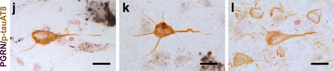 Progranulin Interactions with AD pathological Features. (a-c). Representative photomicrographs of progranulin (PGRN)(purple) immunoreactivity associated with amyloid beta (A beta ) plaques (brown) in MTG sections of low plaque, high plaque and Alzheimer’s disease cases. Scale bar represents 30 μm. (d-f). Photomicrographs of PGRN (purple) immunoreactivity associated with CD45 immunoreactive microglia in MTG sections of low plaque (d), high plaque (e), and Alzheimer’s disease cases (f). Insets a) show at higher magnification PGRN-positive stained neurons present in each section. Neurons are identified by their size and characteristic shape. Insets b) show higher magnification of PGRN-positive microglia. Scale bar represents 20 μm (d-f), and 10 μm for insets. (g-i). Photomicrographs of PGRN (purple) with plaque-associated CD45-positive microglia (brown). Progressive increase in accumulation of CD45-positive microglia in low plaque (g), high plaque (h) and Alzheimer’s disease (i) cases. Scale bar represents 30 μm. (j-o). Absence of PGRN immunoreactivity of neurofibrillary tangles. (j-i) Photomicrographs of PGRN (purple) and phosphorylated tau (AT8)(brown) double-stained sections from low plaque (j), high-plaque (k), and Alzheimer’s disease cases (l). (m-o). Confocal micrographs of PGRN (green) and phosphorylated tau (AT180)-positive tangles in low-plaque (m), high-plaque (n) and Alzheimer’s disease (o) cases. Scale bar represents 10 μm. Image collected and cropped by CiteAb from the following publication (//pubmed.ncbi.nlm.nih.gov/31864418), licensed under a CC-BY license. Not internally tested by R&D Systems.