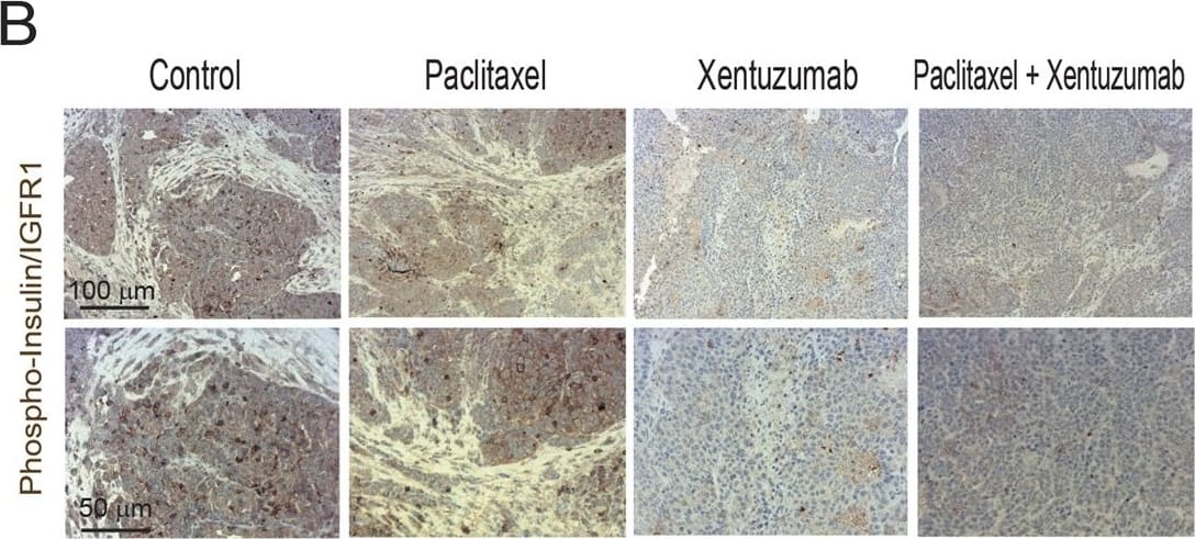 Combined treatment of IGF blocking antibody with paclitaxel decreases breast cancer proliferation and metastasis in Py230 model. a Py230 luciferase cells were orthotopically implanted into the third mammary fatpad of syngeneic C57BL/6 recipient mice and mice were treated, starting when tumors reached between 5–8 mm2, twice a week i.p., with control IgG antibody, IGF blocking antibody xentuzumab (100 mg/kg), paclitaxel (100 mg/kg), or a combination of xentuzumab with paclitaxel (n = 8 mice per group). b Immunohistochemical staining of phospho-insulin/IGF-1R in breast tumors treated with IgG (control), paclitaxel, xentuzumab or paclitaxel + xentuzumab. Scale bars 100 μm and 50 μm. Image collected and cropped by CiteAb from the following publication (//pubmed.ncbi.nlm.nih.gov/29367764), licensed under a CC-BY license. Not internally tested by R&D Systems.