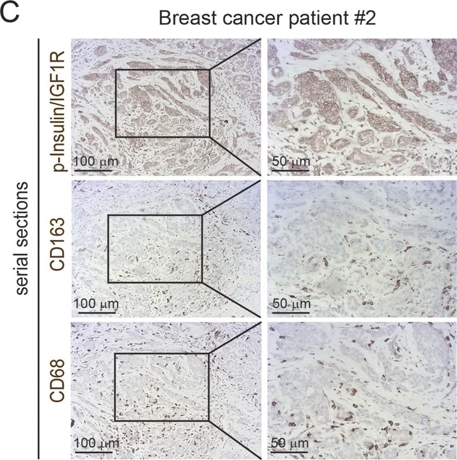 75% of breast cancer patients have activated Insulin/IGF1 receptors and Insulin/IGF-1 receptor activation positively correlates with macrophage infiltration and advanced tumor stage. a Serial sections of biopsies from non-malignant breast tissue immunohistochemically stained for phospho-Insulin/IGF1 receptor, CD163 and CD68. Scale bars, 100 μm and 50 μm. b and c Serial sections of biopsies from breast cancer patients immunohistochemically stained for phospho-insulin/IGF1 receptor, CD163, and CD68. Scale bars, 100 μm and 50 μm. d Bar graph depicting the quantification of CD68 and CD163 positive macrophages in non-malignant breast tissue and breast cancer tissue samples. Error bars represent s.d. (n = 3); * two-tailed p-value ≤ 0.05, *** two-tailed p-value ≤ 0.005 using a student’s t-test. e Pie diagram representing the percentage of phospho-Insulin/IGF-1 receptor positive (red) and negative (green) tumors assessed in a tissue microarray containing biopsies from 75 breast cancer patients. f Contingency table and results from statistical analysis showing a positive correlation between phospho-Insulin/IGF-1 receptor expression in breast tumors and increased CD163+ macrophage infiltration. Chi-square = 4.37; p = 0.04. g Contingency table and results from statistical analysis showing a positive correlation between phospho-Insulin/IGF1 receptor and CD163+ macrophages co-expression and tumor stage. Chi-square = 4.89; p = 0.03 Image collected and cropped by CiteAb from the following publication (//pubmed.ncbi.nlm.nih.gov/29367764), licensed under a CC-BY license. Not internally tested by R&D Systems.