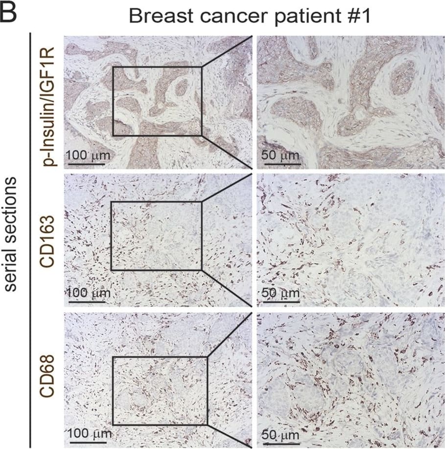 75% of breast cancer patients have activated Insulin/IGF1 receptors and Insulin/IGF-1 receptor activation positively correlates with macrophage infiltration and advanced tumor stage. a Serial sections of biopsies from non-malignant breast tissue immunohistochemically stained for phospho-Insulin/IGF1 receptor, CD163 and CD68. Scale bars, 100 μm and 50 μm. b and c Serial sections of biopsies from breast cancer patients immunohistochemically stained for phospho-insulin/IGF1 receptor, CD163, and CD68. Scale bars, 100 μm and 50 μm. d Bar graph depicting the quantification of CD68 and CD163 positive macrophages in non-malignant breast tissue and breast cancer tissue samples. Error bars represent s.d. (n = 3); * two-tailed p-value ≤ 0.05, *** two-tailed p-value ≤ 0.005 using a student’s t-test. e Pie diagram representing the percentage of phospho-Insulin/IGF-1 receptor positive (red) and negative (green) tumors assessed in a tissue microarray containing biopsies from 75 breast cancer patients. f Contingency table and results from statistical analysis showing a positive correlation between phospho-Insulin/IGF-1 receptor expression in breast tumors and increased CD163+ macrophage infiltration. Chi-square = 4.37; p = 0.04. g Contingency table and results from statistical analysis showing a positive correlation between phospho-Insulin/IGF1 receptor and CD163+ macrophages co-expression and tumor stage. Chi-square = 4.89; p = 0.03 Image collected and cropped by CiteAb from the following publication (//pubmed.ncbi.nlm.nih.gov/29367764), licensed under a CC-BY license. Not internally tested by R&D Systems.