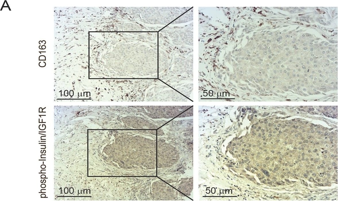 Eighty-seven percent of patients with invasive breast cancer have activated Insulin/IGF1 receptors. a Immunohistochemical staining of invasive breast cancer tissue serial sections stained for phospho-Insulin/IGF1 receptor and CD163. Scale bars, 100 μm and 50 μm. b Upper diagram: Pie diagram representing the percentage of phospho-Insulin/IGF1 receptor positive (red) and negative (green) tumors assessed in tissue microarray (TMA) containing biopsies from 90 consented patients with invasive breast cancer. Lower diagrams: represent the percentage of phospho-Insulin/IGF1 receptor positive (red) and negative (green) tumors of the molecular subsets, TNBC, HR+, and HER2+. c Expression levels of Igf-1, Igf-2, cd163, and mrc1 associated with survival in breast cancer patients Image collected and cropped by CiteAb from the following publication (//pubmed.ncbi.nlm.nih.gov/29367764), licensed under a CC-BY license. Not internally tested by R&D Systems.