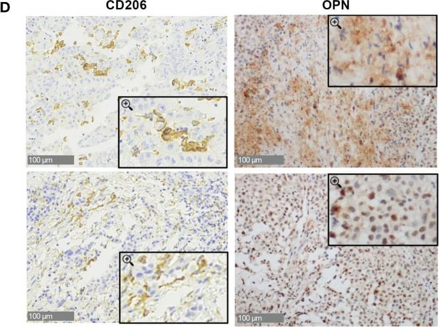 Osteopontin is overexpressed in human MPM patients. (A) Real Time PCR for the Spp1 gene (osteopontin, OPN) in surgical human MPM samples. Comparison between tumor and undiseased adjacent tissues. Data are shown as mean ± SEM (Unpaired t test with Welch’s correction). (B) ELISA quantification of hOPN on plasma samples from 99 MPM patients and 101 healthy subjects. (ROUT, identify outlier and Unpaired t test with Welch’s correction). (C) Kaplan-Meier curves of overall survival according to OPN levels categorized based on CART analysis cut-off (n=61 MPM patients). (D–F) Representative images of immunohistochemistry in MPM tumor tissues stained for OPN or CD206 (40x, insert 100x) and semi-quantitative analysis in 28 cases (0=negative, 1 = 1-25% positivity, 2 = 26-50% positivity, 3= >50% positivity). Data are shown as mean ± SEM. (Unpaired t test with Welch’s correction). (G, H) ELISA quantification of hOPN on plasma samples from 18 MPM patients treated with immunotherapy. Blood was collected at baseline and after revalutation at 4-6 months. Patients with progressive disease (PD): 6 patients; stable disease (SD): 6 patients; partial response (PR): 6 patients. Image collected and cropped by CiteAb from the following open publication (//pubmed.ncbi.nlm.nih.gov/37398648), licensed under a CC-BY license. Not internally tested by R&D Systems.