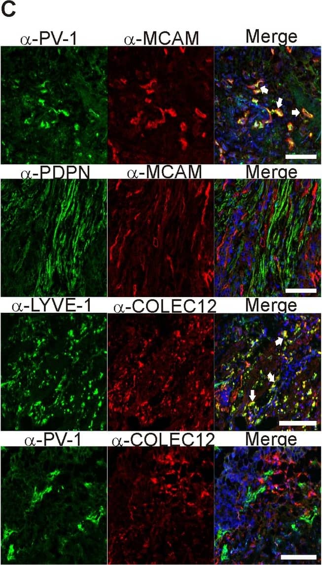 MCAM and COLEC12 are novel BEC- and LEC- specific markers.Two new endothelial markers MCAM and COLEC12 (selected from our analysis of Dataset B) were used to stain (A) normal human lymph nodes together with two established vascular markers PV-1 (for BEC) and CLEVER-1 (for LEC). In addition, (B) chronically inflamed tonsils and (C) specimens from bladder cancer and colorectal cancer were stained with the antibodies against the indicated proteins. LYVE-1 and COLEC12 co-staining was done on colorectal cancer specimens, whereas the other stainings represent bladder cancer. MCAM staining colocalized very well with the established BEC marker PV-1 whereas no colocalization could be detected between MCAM and the established LEC markers LYVE-1 and podoplanin. COLEC12-staining on the other hand showed colocalization with LYVE-1 but not PV-1. White arrows point to areas of colocalization. Nuclear counterstaining was performed with DAPI. Scale bars represent 100 µm. Image collected and cropped by CiteAb from the following publication (//pubmed.ncbi.nlm.nih.gov/24058540), licensed under a CC-BY license. Not internally tested by R&D Systems.