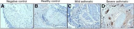 IL-22 and IL-22 receptor expression levels increase in the airways of asthmatic subjects. (A-D) Bronchial biopsies were obtained from healthy controls, mild asthmatics and severe asthmatics and stained (A, negative control) for IL-22 expression (in brown) by immunohistochemistry. Scale bar 50 μm. (E) The number of IL-22 positive cells was determined per mm2 of biopsy tissue. n=5 per group, *p<0.05 vs. healthy control. (F) Primary bronchial epithelial cells were obtained from healthy controls, mild asthmatics and severe asthmatics and assessed for IL-22 receptor expression by Western blot. Cells were allowed to grow to confluence, serum starved overnight and stimulated with IL-22, TGF-beta 1 (10 ng/mL each) or both cytokines for 5 days before Western blot analysis. (G) Expression levels of the IL-22 receptor in unstimulated cells were quantified relative to GAPDH expression. n=5 per group, *p<0.05 vs. healthy control. Image collected and cropped by CiteAb from the following publication (//respiratory-research.biomedcentral.com/articles/10.1186/1465-9921-14-118), licensed under a CC-BY license. Not internally tested by R&D Systems.