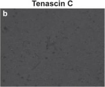 Breast cancer brain metastases exhibit remodeled extracellular matrix. Non-cancerous control brain resections (a–c) and breast cancer brain metastases resections (d–f) were stained for collagen I (anti-collagen I), tenascin C (anti-tenascin C), and hyaluronan (hyaluronic acid binding protein). Representative images were selected across six patients (n = 6). Scale bar = 200 μm. Image collected and cropped by CiteAb from the following open publication (//pubmed.ncbi.nlm.nih.gov/35200398), licensed under a CC-BY license. Not internally tested by R&D Systems.