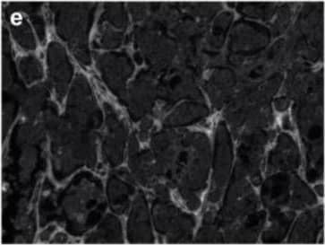 Breast cancer brain metastases exhibit remodeled extracellular matrix. Non-cancerous control brain resections (a–c) and breast cancer brain metastases resections (d–f) were stained for collagen I (anti-collagen I), tenascin C (anti-tenascin C), and hyaluronan (hyaluronic acid binding protein). Representative images were selected across six patients (n = 6). Scale bar = 200 μm. Image collected and cropped by CiteAb from the following open publication (//pubmed.ncbi.nlm.nih.gov/35200398), licensed under a CC-BY license. Not internally tested by R&D Systems.