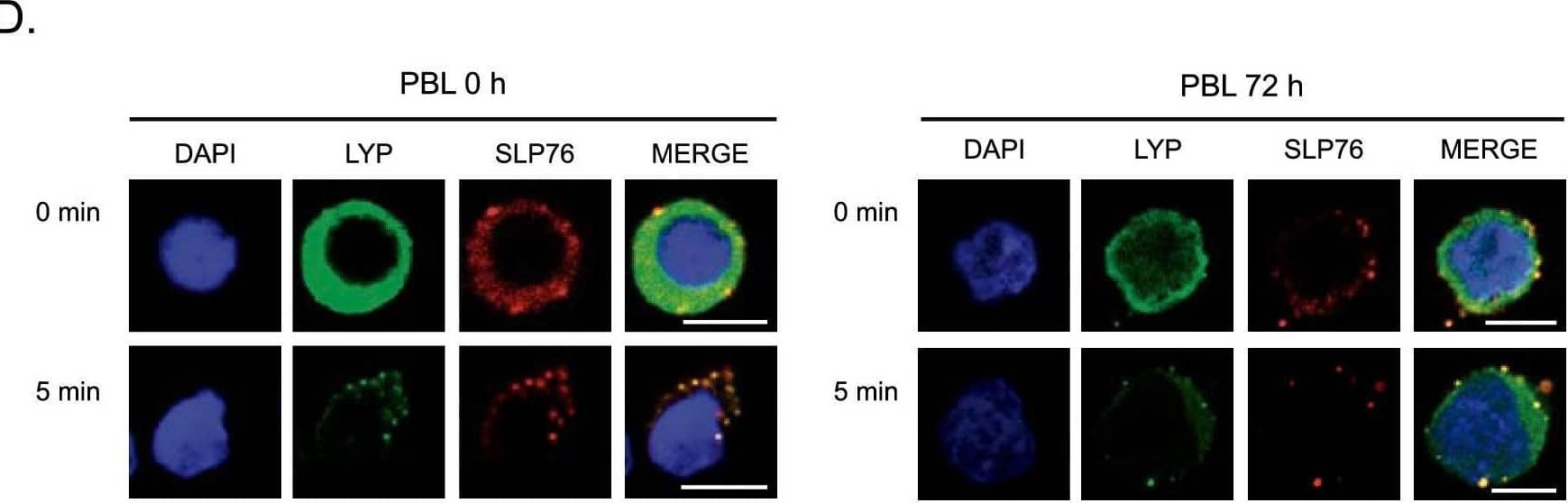 LYP co-localizes with SLP76 in T cell microclusters. Jurkat cells (A) or PBL (B) were plated on coverslips covered with antibody for CD3 for the indicated periods of time. Then, cells were fixed and stained with specific antibodies for SLP76 and LYP, as indicated. Images were taken with a confocal microscope and representative images are shown. C, Wild type and 494 Jurkat cell lines were plated on coverslips covered with CD3 antibody for the indicated periods of time. Then, cells were fixed and stained with specific antibodies for SLP76. D, PBL cells were left untreated or stimulated with PHA for 72 h to induce the expression of LYP. As before, they were plated on stimulatory coverslips and processed to detect LYP and SLP76 by immunofluorescence with a confocal microscope. E, LYP expression in PLB treated with PHA. Scale bar represents 5 μm Image collected and cropped by CiteAb from the following open publication (//pubmed.ncbi.nlm.nih.gov/39342392), licensed under a CC-BY license. Not internally tested by R&D Systems.