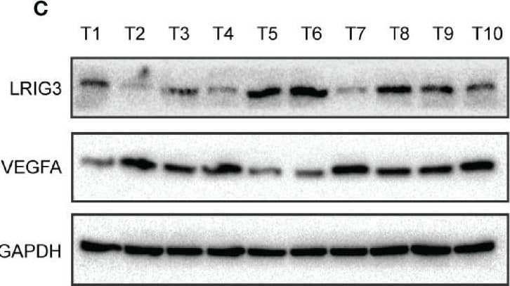 Clinical relevance of LRIG3, p-AKT, and VEGFA expression in gliomas. (A) IHC staining targeting LRIG3, p-AKT, and VEGFA in two representative GBM specimens. Brown staining, positive immunoreactivity. (B) Relative levels of LRIG3, p-AKT, and VEGFA proteins in GBM specimens (with low and high LRIG3 expression levels in 28 GBM patients). (C) Expression analysis (left) and correlation (right) between LRIG3 and VEGFA expression in 10 freshly collected human glioma samples. Data are means ± SD of 3 independent replicates. ***p < 0.001. Image collected and cropped by CiteAb from the following open publication (//pubmed.ncbi.nlm.nih.gov/33718179), licensed under a CC-BY license. Not internally tested by R&D Systems.