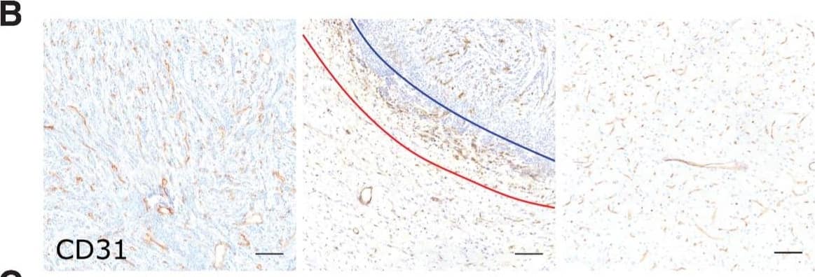 Microvascular and tumor cell biology at the tumor rim in U87MG glioblastoma. Representative histologic sections of rat brains, intrastriatally injected with U87MG tumor cells, from the tumor core, tumor rim, and the contralateral striatum, with corresponding box and whisker plots of marker expression in each region. Data shown as median ± interquartile range. Sections were immunohistochemically stained (brown) for tumor cell marker vimentin (A), endothelial marker CD31 (B), cell adhesion molecule VCAM-1 (C), cell proliferation marker Ki67 (D), and two stemness markers: SOX2 (E) and nestin (F). Scale bar = 100 μm. *, P < 0.05; **, P < 0.01; ***, P < 0.001; n = 5; post hoc Bonferroni multiple comparison test for tumor cell density and microvessel density, and post hoc Dunn test for VCAM-1 expression. Tumor core was delineated from the infiltrative border as indicated by the blue and red lines, respectively. Expression of Ki67, nestin, and SOX2 has been normalized to tumor area. **, P < 0.01; matched Wilcoxon test. Image collected and cropped by CiteAb from the following open publication (//pubmed.ncbi.nlm.nih.gov/35312755), licensed under a CC-BY license. Not internally tested by R&D Systems.