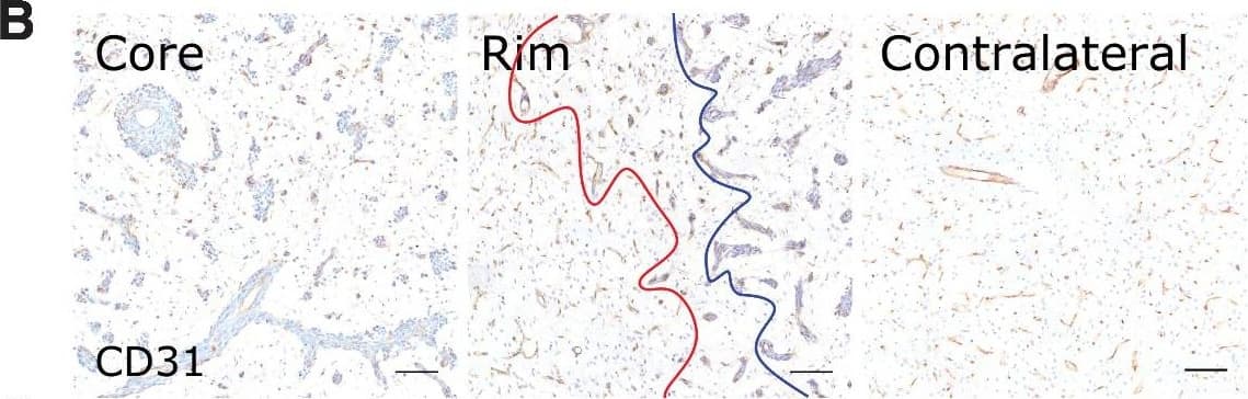 Microvascular and tumor cell biology at the tumor rim in MDA231Br-GFP brain metastases. Representative histologic sections of rat brains, intrastriatally injected with MDA231Br-GFP tumor cells, from the tumor core, tumor rim, and the contralateral striatum, with corresponding box and whisker plots of marker expression in each region. Data shown as median ± interquartile range. Sections were immunohistochemically stained (brown) for tumor cell marker vimentin (A), endothelial marker CD31 (B), cell adhesion molecule VCAM-1 (C), cell proliferation marker Ki67 (D), and two stemness markers: SOX2 (E) and nestin (F). Scale bar = 100 μm. *, P < 0.05; ***, P < 0.001; n = 8; post hoc Bonferroni multiple comparison test for tumor cell density and microvessel density, and post hoc Dunn test for VCAM-1 expression. Tumor core was delineated from the infiltrative border as indicated by the blue and red lines, respectively. Expression of Ki67, nestin and SOX2 has been normalized to tumor area. *, P < 0.05; ***, P < 0.001; matched Wilcoxon test. Image collected and cropped by CiteAb from the following open publication (//pubmed.ncbi.nlm.nih.gov/35312755), licensed under a CC-BY license. Not internally tested by R&D Systems.