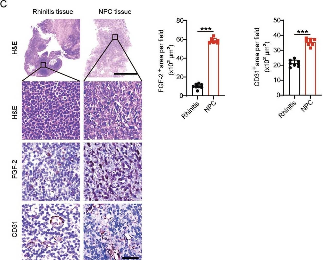 FGF-2 expression in NPC correlates with tumor vasculature.A Transcriptomic expression levels of angiogenic factors, including VEGFA, FGF2, PDGFB, EGF, ANGPT1, EPO in human KIRC tissues, COAD tissues, NPC tissues, STAD tissues, PAAD tissues, LUAD tissues, BRCA tissues, SKCM tissues, and their adjacent healthy tissues. The red line indicates the highest expression of FGF2 in AAD-resistant NPC and the lowest expression of FGF in AAD-sensitive CRC. B Transcriptomic expression levels of FGF2 in NPC tissues, COAD tissues, and their adjacent healthy tissues (sample number: control-NPC/NPC/control-COAD/COAD = 10/31/41/290). Data were extracted from datasets GSE12452 and TCGA. C Human rhinitis tissues and NPC tissues were collected and detected for histology (H&E), FGF-2, and CD31 expression levels. Scale bar in upper panel = 500 μm, scale bar in lower three panels = 50 μm. Quantification of FGF-2+ or CD31+ signals (n = 8 random fields per group). D QPCR quantification of FGF2 and CD31 expression in freshly collected rhinitis tissues and NPC tissues (rhinitis tissue, n = 5 samples; NPC tissue, n = 6 samples). E Correlation of FGF2 and CD31 transcriptomic expression levels of human NPCs and control rhinitis tissues (Rhinitis tissue, n = 5 samples; NPC tissue, n = 6 samples). *P < 0.05; ***P < 0.001. NS not significant. Data presented as mean ± SD. KIRC kidney renal clear cell carcinoma, COAD colon adenocarcinoma, STAD stomach adenocarcinoma, PAAD pancreatic adenocarcinoma, LUAD lung adenocarcinoma, BRCA breast invasive carcinoma, SKCM skin cutaneous melanoma. Image collected and cropped by CiteAb from the following open publication (//pubmed.ncbi.nlm.nih.gov/35985991), licensed under a CC-BY license. Not internally tested by R&D Systems.