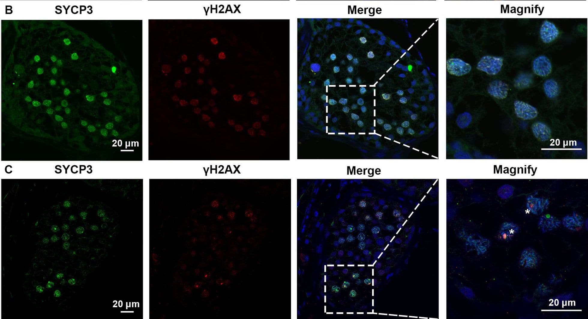 Expression of SYCP3 and  gamma H2AX in the testis of the patient with SYCE1 CNVs and OA-affected patient as a positive control. A–C Immunofluorescence staining showed the expression of SYCP3 (Green) and  gamma H2AX (Red) in the testis of the patient P6326 (A), P10377 (B), and the patient with OA as a positive control (C) Scale bars = 20 μm in A–D. And the arrowhead indicated the XY body in the spermatocytes in the testis of the patient with OA Image collected and cropped by CiteAb from the following open publication (//pubmed.ncbi.nlm.nih.gov/35718780), licensed under a CC-BY license. Not internally tested by R&D Systems.