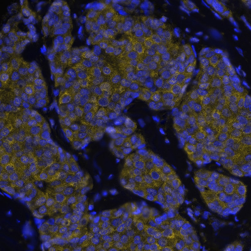 Phospho-GSK3a was detected in immersion fixed paraffin-embedded sections of human breast cancer using Rabbit Anti-Human phospho-GSK3a Monoclonal Antibody (Catalog # AF4125) at 25ug/mL at 27 ° Celsius for 4 minutes. Before incubation with the primary antibody, tissue underwent an all-in-one dewaxing and antigen retrieval preprocessing using PreTreatment Module (PT Module) and Dewax and HIER Buffer H (pH 9; Epredia Catalog # TA-999-DHBH). Tissue was stained using the Alexa Fluor™ Plus 555 Goat anti-Rabbit IgG Secondary Antibody at 1:100 at 37 ° Celsius for 2 minutes. (Yellow; Lunaphore Catalog # DR555RB) and counterstained with DAPI (blue; Lunaphore Catalog # DR100). Specific staining was localized to the cytoplasm and nucleus. Protocol available in COMET™ Panel Builder.