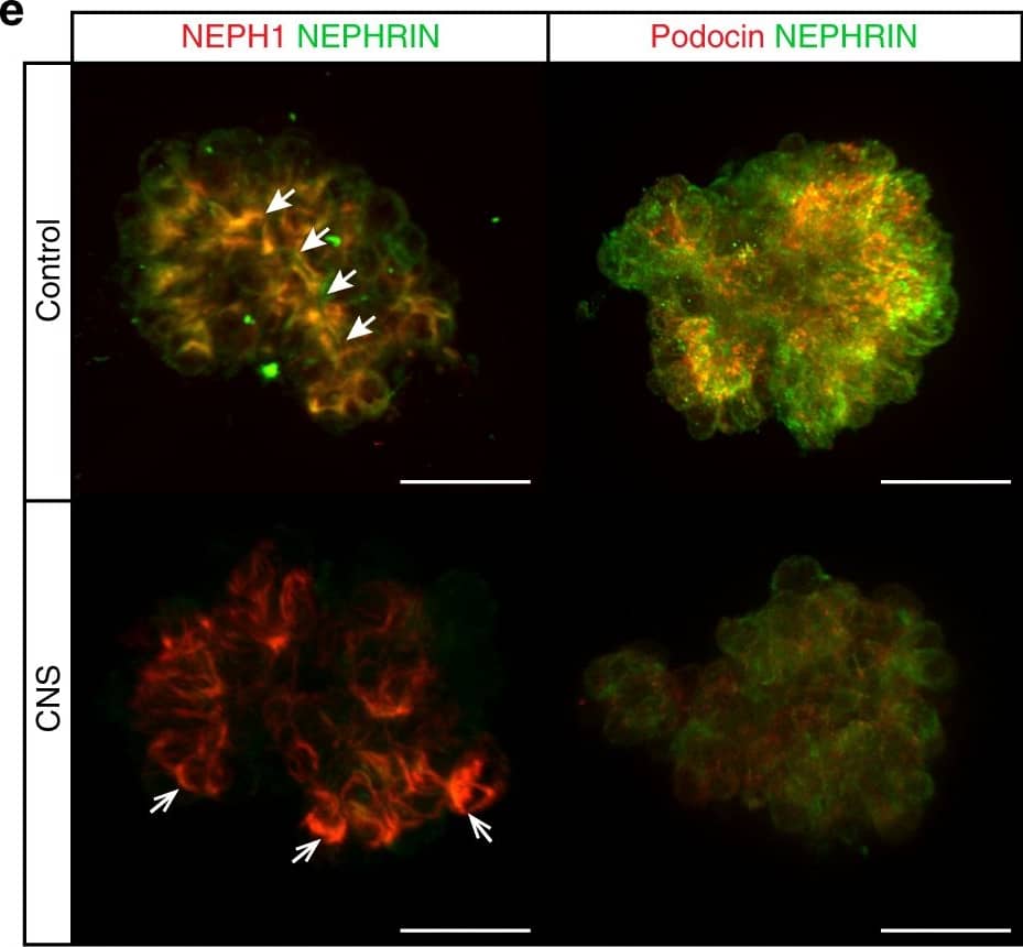 Organoid Glomeruli model of congenital nephrotic syndrome in vitro. a Description of the NPHS1 variants identified in the patient modelled, diagnosed with congenital nephrotic syndrome (CNS). b–d Immunostaining of OrgGloms isolated from control organoids and CNS patient organoids show reduced NEPHRIN and PODOCIN protein levels in the organoids derived from patient-iPSC, representative images shown of >3 biological replicates. Scale bars 10 µm. e Higher power immunofluorescent images show the polarised co-localisation of NEPHRIN with NEPH1 (solid white arrowheads) and PODOCIN in control OrgGloms. This polarisation is lost in CNS OrgGloms due to the absence of NEPHRIN (white arrows). Scale bars 10 µm. f Quantitative analysis of fluorescence intensities from independent OrgGlom biological replicates performed using one control and two distinct patient-derived CNS iPSC clones. Organoid glomeruli generated from both patient-derived iPSC clones show significant reduction in NEPHRIN and PODOCIN protein levels. Two-way ANOVA p < 0.0001; error bars = SEM. Biological replicates. NEPHRIN (controls, n = 20; CNS, n = 56); PODOCIN (controls, n = 14; CNS, n = 22); CD2AP (controls, n = 8; CNS, n = 15); NEPH1 (controls, n = 10; CNS, n = 17). Significant difference assessed by Sidak’s multiple comparisons test between cell lines; F-value = 112; DF = 1. NEPHRIN: control vs CNS#1, p < 0.0001; control vs CNS#2, p < 0.0001; CNS#1 vs CNS#2, p > 0.9999. PODOCIN: control vs CNS#1, p < 0.0001; control vs CNS#2, p < 0.0001; CNS#1 vs CNS#2, p = 0.9995. CD2AP: control vs CNS#1, p = 0.0007; control vs CNS#2, p = 0.0016; CNS#1 vs CNS#2, p = 0.9980. NEPH1: control vs CNS#1, p = 0.5320; control vs CNS#2, p = 0.9994; CNS#1 vs CNS#2, p = 0.9992. g Quantitative western blot analysis of NEPHRIN and PODOCIN protein levels within independent biological replicates confirms the significant depletion of these proteins in OrgGloms derived from CNS iPSCs Image collected and cropped by CiteAb from the followin