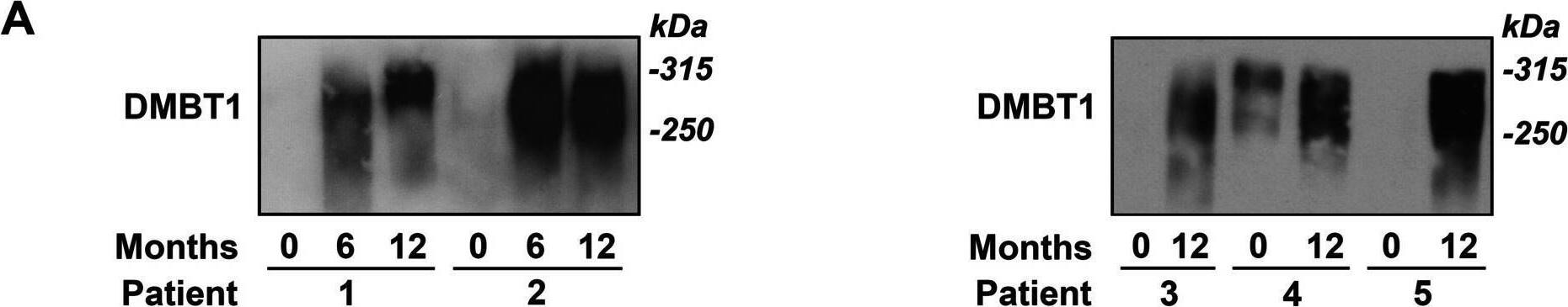 DMBT1 secretion is suppressed in saliva from untreated SCC patients. DMBT1 levels were analyzed at baseline and 6 and 12 months for each patient. A Representative immunoblots of DMBT1 in saliva samples normalized to sample volume. B, C Log-transformed values. P values were determined using linear mixed models with compound symmetric variance structure assumed and baseline as a reference category. B Densitometric quantification of immunoblot data normalized to sample volume. C DMBT1 levels in saliva samples as determined by ELISA. D, E Each DMBT1 measure from immunoblot and ELISA quantification, respectively, was log-transformed Image collected and cropped by CiteAb from the following open publication (//pubmed.ncbi.nlm.nih.gov/38037123), licensed under a CC-BY license. Not internally tested by R&D Systems.