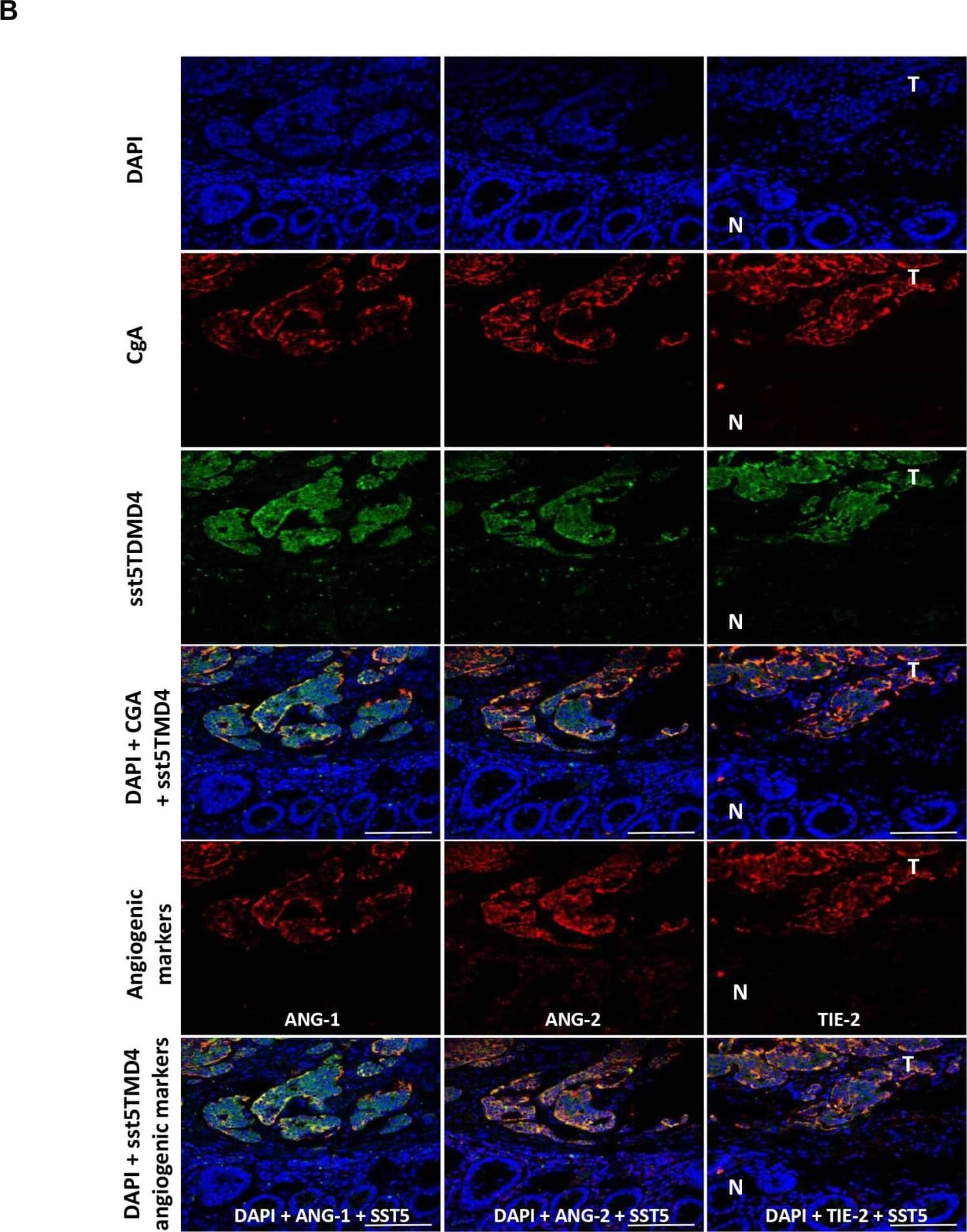 Expression of sst5TMD4 and co-localization with angiogenic marker in GEP-NET(A) Analysis of expression of angiogenic molecules and sst5TMD4 by specific serial immunohistochemistry in a pancreatic NET. Original magnification ×100 and ×400 (insets). N: normal tissue; T: tumor tissue. For specific immunostaining techniques see the “Materials and methods” section. (B) Expression of sst5TMD4 and angiogenic molecules by triple immunofluorescence in a gastrointestinal NET sample. Original magnification ×400. N: normal tissue; T: tumor tissue. For specific immunofluorescence techniques see the “Materials and methods” section. Scale bar for 100 μm is represented with a line for each Figure. Image collected and cropped by CiteAb from the following open publication (//pubmed.ncbi.nlm.nih.gov/26673010), licensed under a CC-BY license. Not internally tested by R&D Systems.