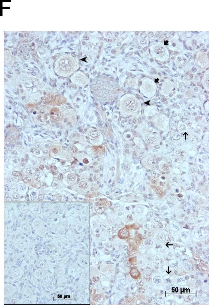 GDF9 is expressed in the human fetal ovary.qRT-PCR analysis of GDF9 (A), BMP15 (B) and NOBOX (C) mRNA expression in human fetal ovary across the gestational range of 8 to 20 weeks. Ovaries (n = 5–7 per group) were grouped according to developmental stage and transcript levels measured relative to those of RPL32. Bars indicate mean±sem. Statistically different levels are indicated by asterisks above the columns, thus expression of GDF9 at 18–20 weeks was significantly higher than at 8–11 weeks (p<0.005) as was expression of BMP15 and of NOBOX (both p<0.01). DAB immunohistochemical detection of GDF9: 19 week (D, E) and 20 week (F) human fetal ovary stained with anti-GDF9 antibody or normal goat IgG negative control (F inset)—positive staining is brown. Thick arrows indicate primordial follicles and thin arrows germ cells that are not stained for GDF9 while the arrowheads indicate primordial follicles that are positive for GDF9. Scale bars are 50μm (D and F) and 20μm (E). Image collected and cropped by CiteAb from the following open publication (//pubmed.ncbi.nlm.nih.gov/25790371), licensed under a CC-BY license. Not internally tested by R&D Systems.