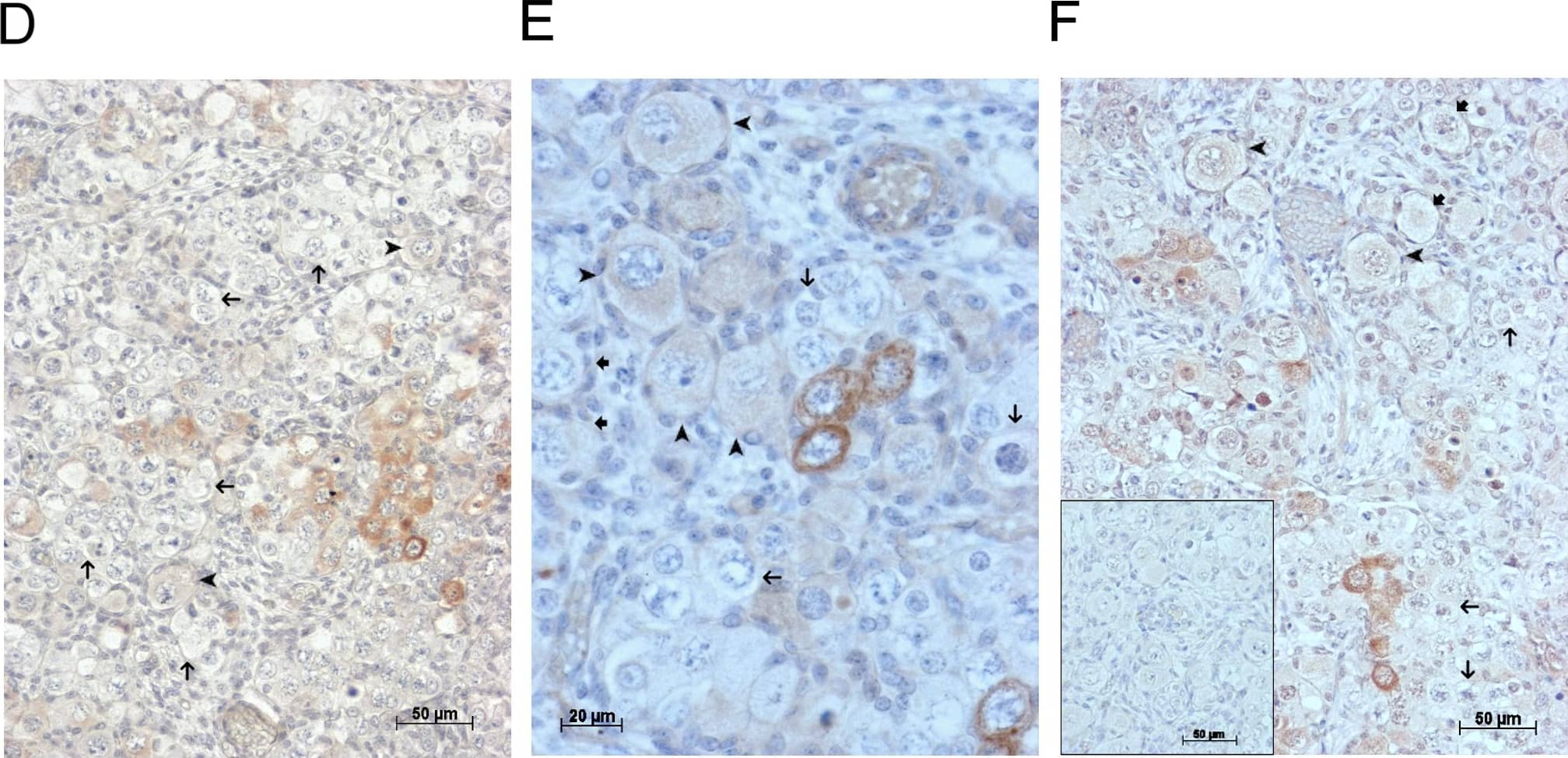GDF9 is expressed in the human fetal ovary.qRT-PCR analysis of GDF9 (A), BMP15 (B) and NOBOX (C) mRNA expression in human fetal ovary across the gestational range of 8 to 20 weeks. Ovaries (n = 5–7 per group) were grouped according to developmental stage and transcript levels measured relative to those of RPL32. Bars indicate mean±sem. Statistically different levels are indicated by asterisks above the columns, thus expression of GDF9 at 18–20 weeks was significantly higher than at 8–11 weeks (p<0.005) as was expression of BMP15 and of NOBOX (both p<0.01). DAB immunohistochemical detection of GDF9: 19 week (D, E) and 20 week (F) human fetal ovary stained with anti-GDF9 antibody or normal goat IgG negative control (F inset)—positive staining is brown. Thick arrows indicate primordial follicles and thin arrows germ cells that are not stained for GDF9 while the arrowheads indicate primordial follicles that are positive for GDF9. Scale bars are 50μm (D and F) and 20μm (E). Image collected and cropped by CiteAb from the following open publication (//pubmed.ncbi.nlm.nih.gov/25790371), licensed under a CC-BY license. Not internally tested by R&D Systems.