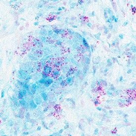 MKi67 mRNA (red) and MKi67 protein (green) were detected in formalin-fixed paraffin-embedded tissue sections of human breast cancer. ACD’s Integrated Co-Detection Workflow was performed using ACD RNAScope Probe Hs-MKI67 (Catalog # 591771) and sheep anti-human Ki67/MKI67 polyclonal antibody (AF7617) at 5 μg/mL. Tissue was stained using RNAscope® 2.5 HD Detection Kit-RED (Catalog # 322360) and RNAscope® 2.5 LS Green Accessory Pack (Catalog # 322550). Tissue was counterstained with 50% hematoxylin (blue).