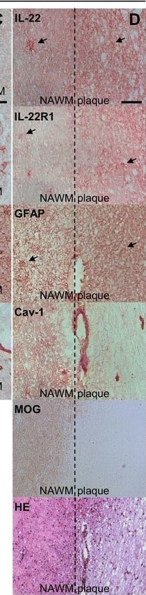 IL-22 and IL-22R1 are expressed in human brain. IL-22, IL-22R1, GFAP, and Caveolin-1 immunohistochemistry peroxidase stainings of brain tissue sections of control (a) and MS (b–d) patients. MOG and HE stainings were used to detect MS demyelinating plaques (d). All four pictures belonging to one column (a, b, c, or d) were always immediately adjacent to each other. Pictures a, b, and c were taken at areas at the border between GM and NAWM, whereas pictures in d were taken from the same location at the edge between NAWM and a plaque. Inserts in columns a and b represent a threefold magnification of the selected area. Arrow: astrocyte-like pattern. a study patient B-C2, b and d study patient B-MS3, c study patient B-MS5 (Table 2). Scale bar, 50 μm (a, b: ×20, c, d ×40). GM: gray matter, NAWM: normal appearing white matter, WM: white matter. Representative pictures obtained from the observations of seven control and five MS autopsy samples Image collected and cropped by CiteAb from the following publication (//pubmed.ncbi.nlm.nih.gov/26077779), licensed under a CC-BY license. Not internally tested by R&D Systems.