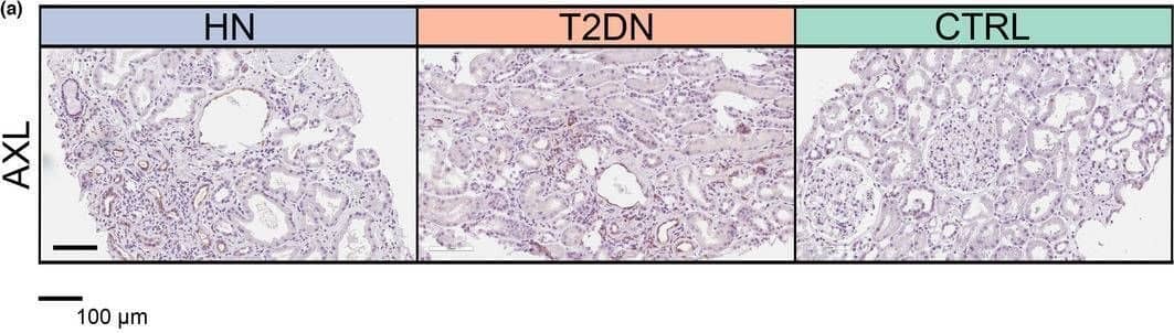 Elevated AXL Protein Levels in HN and T2DN Tissues and Serum. (a) AXL immunohistochemistry staining. (b) Ratio of strong positive pixels to total section area. (c) ELISA results for soluble AXL in serum from HN and control patients (n = 13 for HN, n = 14 for control). (d) ELISA results for serum from T2DN/T1DN and control patients (n = 7 for T2DN, n = 2 for T1DN, n = 9 for control). Measurements are presented in ng/mL. p‐values from ImageScope analyses are based on the Kruskal–Wallis test. Image collected and cropped by CiteAb from the following open publication (//pubmed.ncbi.nlm.nih.gov/37813528), licensed under a CC-BY license. Not internally tested by R&D Systems.