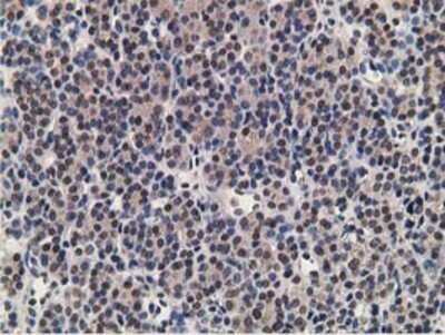 Immunohistochemistry: alcohol dehydrogenase 1B Antibody (OTI4F12) - Azide and BSA Free [NBP2-70092] - Staining of paraffin-embedded Carcinoma of Human thyroid tissue using anti-alcohol dehydrogenase 1B mouse monoclonal antibody.