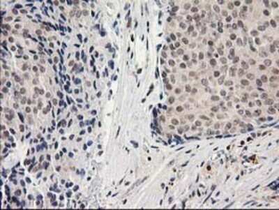 Immunohistochemistry: alcohol dehydrogenase 1B Antibody (OTI4F12) - Azide and BSA Free [NBP2-70092] - Staining of paraffin-embedded Adenocarcinoma of Human breast tissue using anti-alcohol dehydrogenase 1B mouse monoclonal antibody.