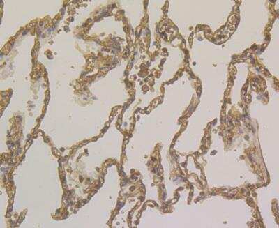 Immunohistochemistry: alpha 1-Acid Glycoprotein Antibody (A2-B10) [NBP2-76901] - Immunohistochemical analysis of paraffin-embedded human lung cancer tissue using anti-Alpha-1-acid glycoprotein antibody. Counter stained with hematoxylin.