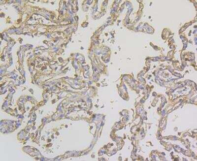 Immunohistochemistry: alpha 1-Acid Glycoprotein Antibody (A4-G2-A3) [NBP2-76902] - Immunohistochemical analysis of paraffin-embedded human lung cancer tissue using anti-Alpha-1-acid glycoprotein antibody. Counter stained with hematoxylin.