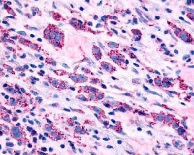 Immunohistochemistry-Paraffin: alpha-1B Adrenergic R/ADRA1B Antibody [NLS698] - Analysis of anti-ADRA1B antibody with human breast, carcinoma.