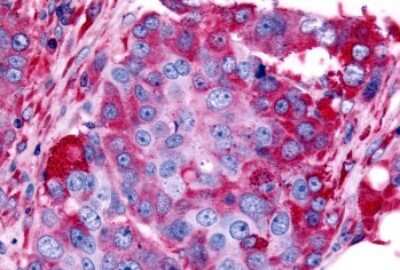 Immunohistochemistry-Paraffin: alpha-1B Adrenergic R/ADRA1B Antibody [NLS698] - Anti-ADRA1B antibody IHC of human Ovary, Carcinoma. Immunohistochemistry of formalin-fixed, paraffin-embedded tissue after heat-induced antigen retrieval.