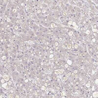 Immunohistochemistry-Paraffin: alpha 1B-Glycoprotein Antibody [NBP2-33419] - Staining of human Liver cancer shows moderate extracellular space positivity in tumor cells.