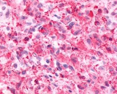Immunohistochemistry-Paraffin: alpha-2C Adrenergic R/ADRA2C Antibody [NLS3990] - Analysis of anti-ADRA2C antibody with human brain, glioblastoma.
