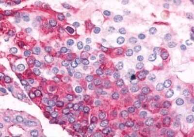 Immunohistochemistry-Paraffin: alpha-2C Adrenergic R/ADRA2C Antibody [NLS3990] - Anti-ADRA2C antibody IHC of human Prostate, Carcinoma. Immunohistochemistry of formalin-fixed, paraffin-embedded tissue after heat-induced antigen retrieval.