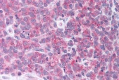 Immunohistochemistry-Paraffin: alpha-Aminoadipate Aminotransferase Antibody [NBP3-14538] - Immunohistochemistry of formalin-fixed, paraffin-embedded human lymph node, non-Hodgkins lymphoma, after heat-induced antigen retrieval.