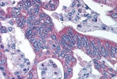 Immunohistochemistry-Paraffin: alpha-Aminoadipate Aminotransferase Antibody [NBP3-14538] - Immunohistochemistry of formalin-fixed, paraffin-embedded human colon carcimona after heat-induced antigen retrieval.