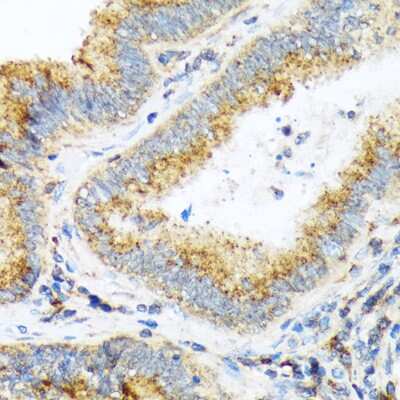 Immunohistochemistry-Paraffin: alpha COP I Antibody (3W6Y6) [NBP3-15839] - Immunohistochemistry of paraffin-embedded human colon carcinoma using alpha COP I Rabbit mAb (NBP3-15839) at dilution of 1:100 (40x lens).Perform microwave antigen retrieval with 10 mM Tris/EDTA buffer pH 9.0 before commencing with IHC staining protocol.