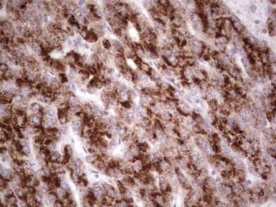 Immunohistochemistry: alpha Desmuslin Antibody (7H6) [NBP2-46044] - Analysis of Carcinoma of Human liver tissue.