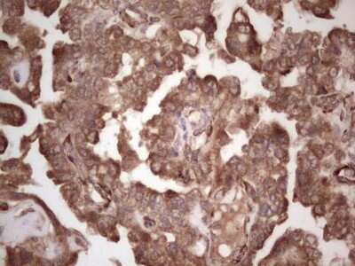 Immunohistochemistry: alpha Desmuslin Antibody (7H6) [NBP2-46044] - Analysis of Adenocarcinoma of Human ovary tissue.