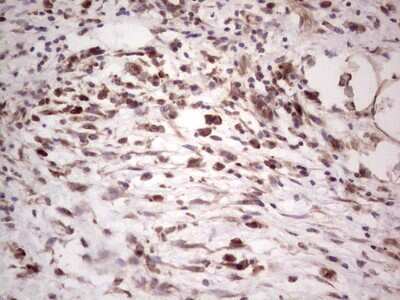 Immunohistochemistry: alpha Desmuslin Antibody (7H6) [NBP2-46044] - Analysis of Carcinoma of Human pancreas tissue.