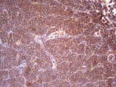 Immunohistochemistry: alpha Desmuslin Antibody (7H6) [NBP2-46044] - Analysis of Human lymphoma tissue.